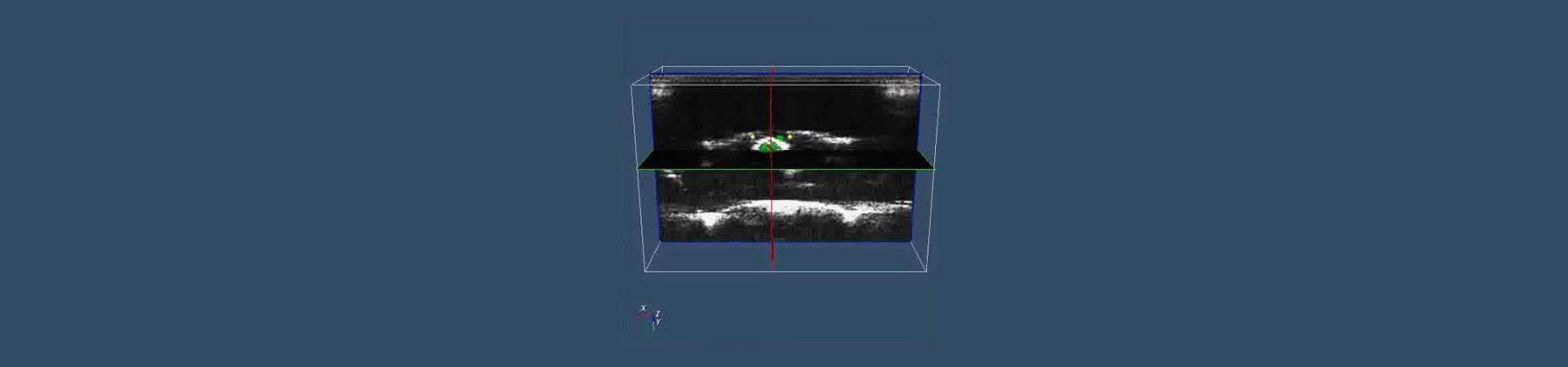 2D/3D real-time ultrasound elastography