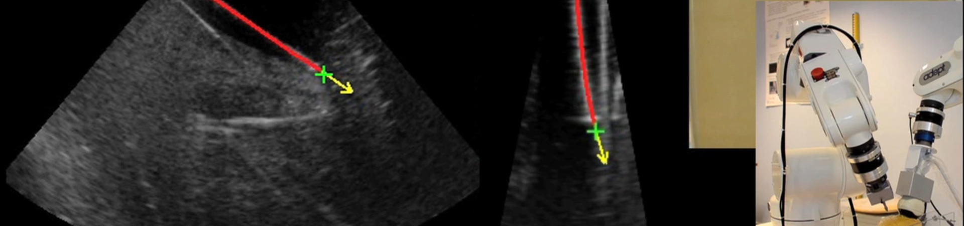 Needdle tracking in ultrasound images